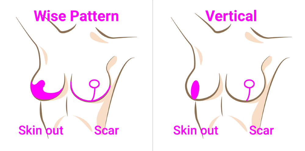 Most Commonly Asked Questions about Mastopexy/Breast Lift Surgery