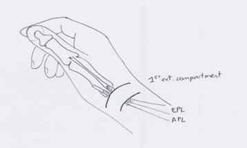 DE QUERVAIN’S TENOSYNOVITIS