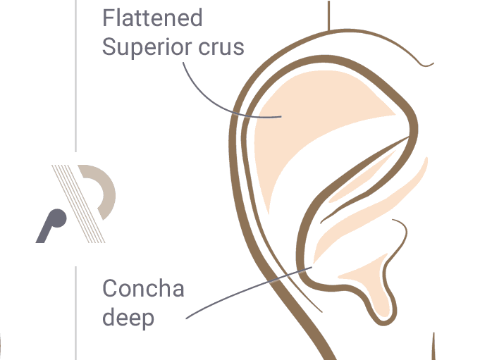 Prominent Ear Correction